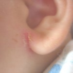 耳切れはアトピーの前兆？アトピーに多い耳切れの原因と治し方の紹介